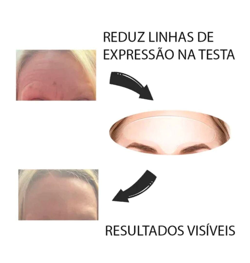 Botox - Livre de rugas e linhas de expressões!